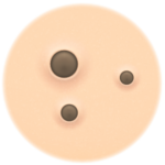Blackhead Treatment
