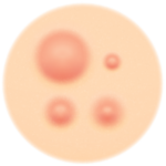 Cystic Acne Treatment