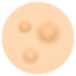 Acne Nodules Treatment
