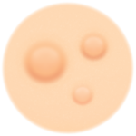 Acne Papules Treatment