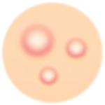 Acne Pustules Treatment