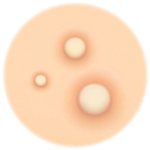 Whitehead Treatment