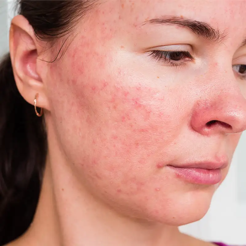 Acne Scar Treatment
