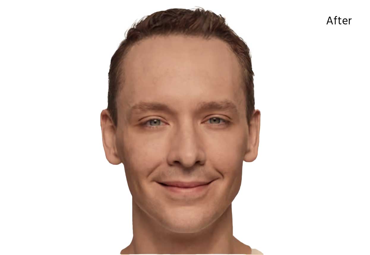 best dermal fillers near me