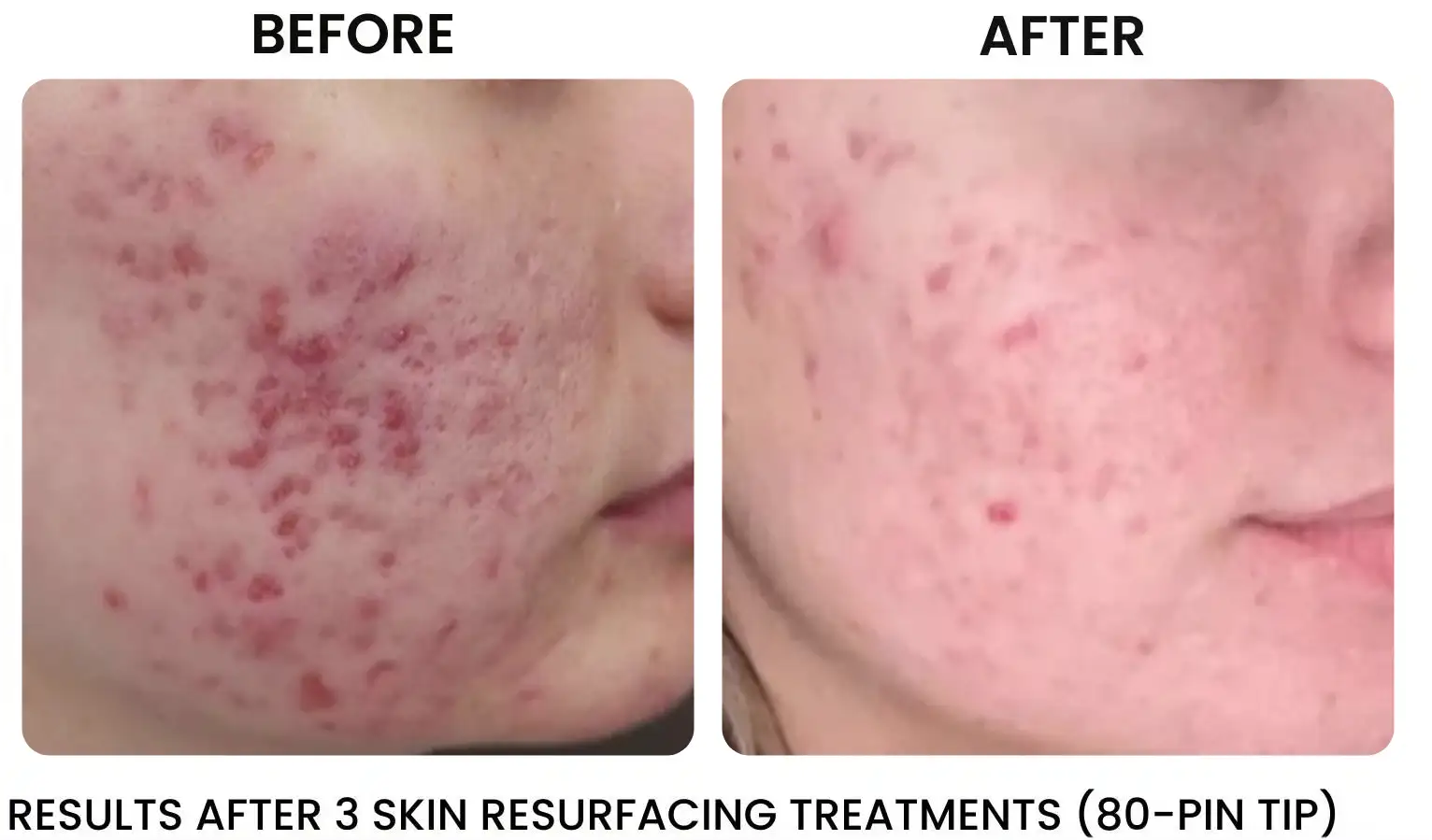 resurfacing facial for acne scars