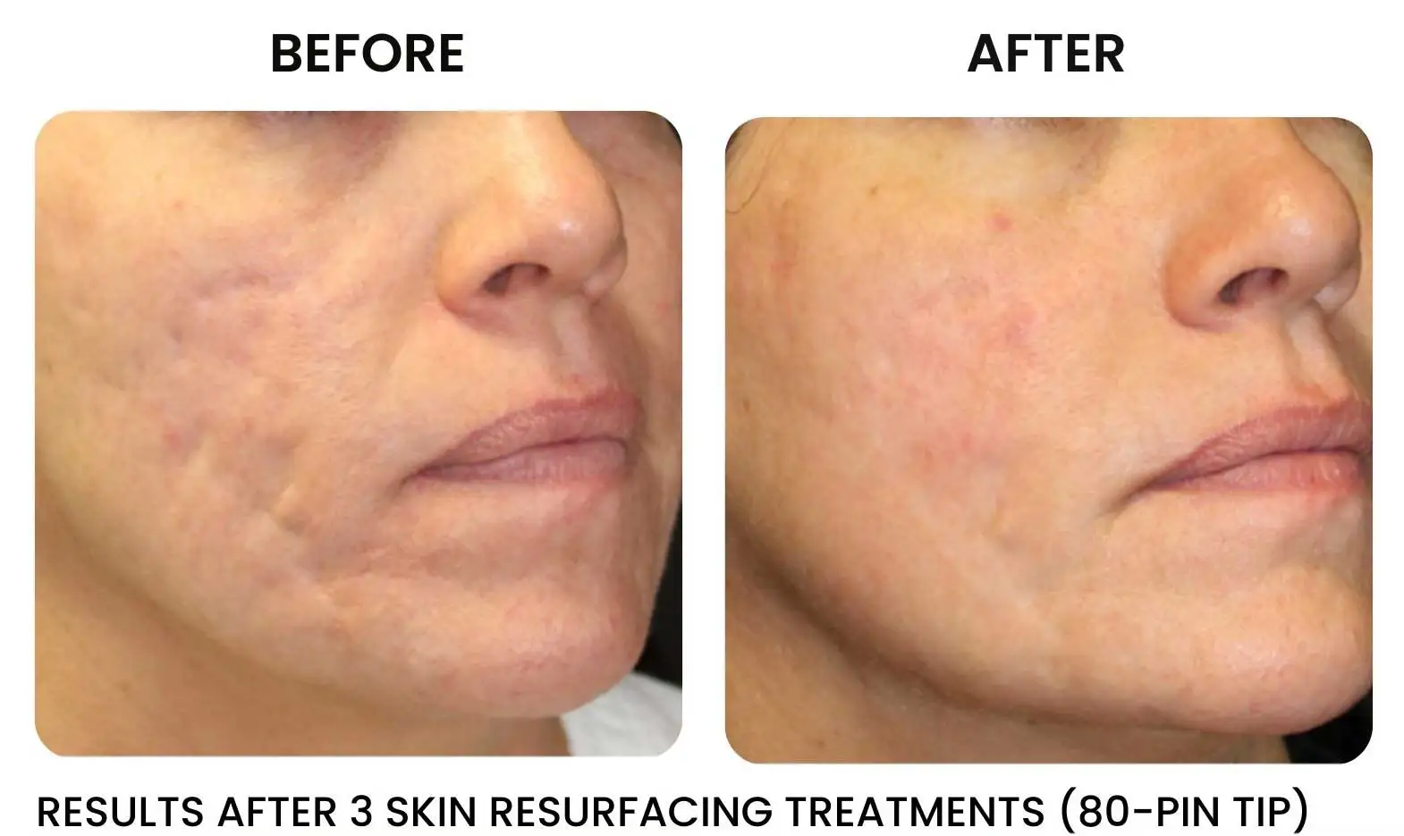 skin resurfacing Rochester NY