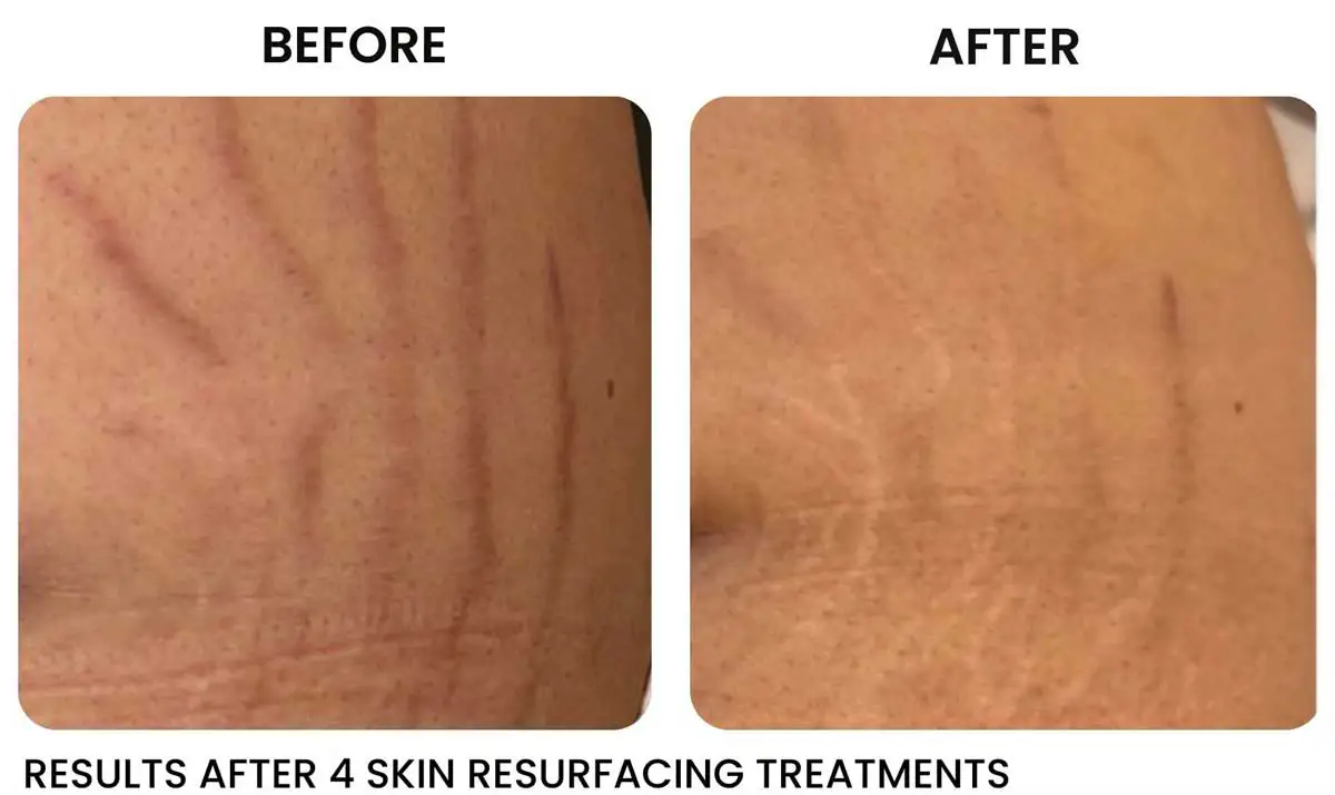 radiofrequency stretch mark treatment