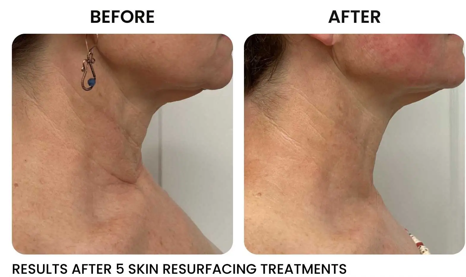 rf skin tightening near me