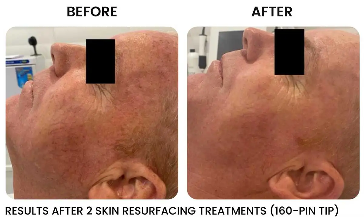 rf skin tightening Rochester NY