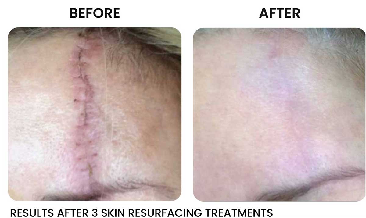 rf microneedling rochester ny