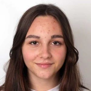 acne laser treatments rochester ny
