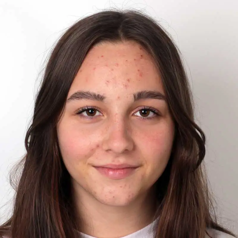 acne laser treatments rochester ny