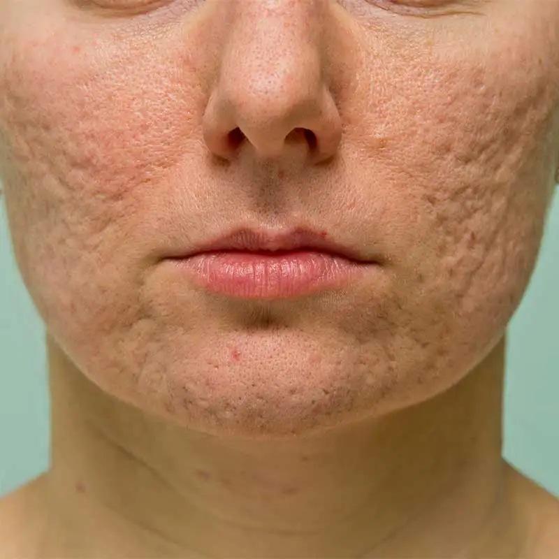 Textured Skin Treatments at Refresh MedSpa