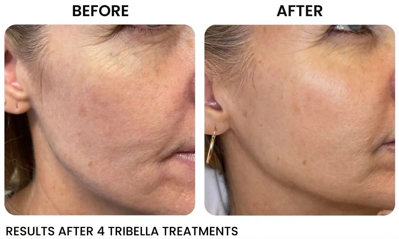 Tribella Skin Resurfacing Before and After